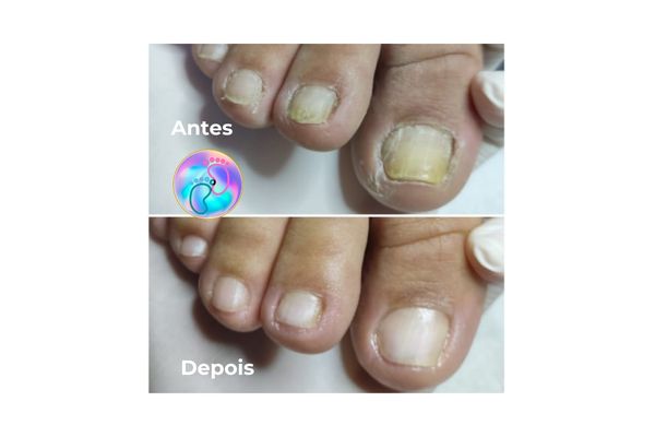 Foto de antes e depois do tratamento 38